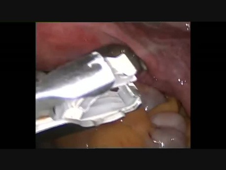Laparoskopische Tuballigatur mit Filshie-Clips
