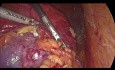 Laparoskopische partielle Nephrektomie, Neoplasma am oberen Pol