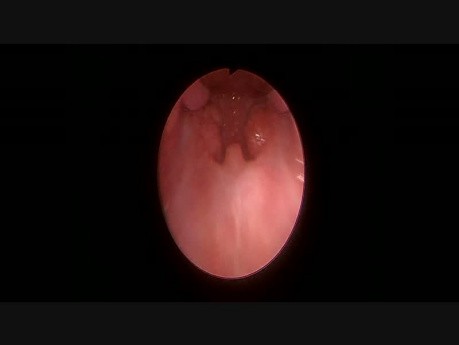 Endoskopisches Bild des Rachens während der Tonsillektomie mit dem Boyle Davis Gag Set