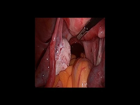 Tubargravidität- Laparoskopie