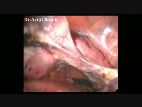 Totale laparoskopische Hysterektomie und bilaterale Salpingo-Oophorektomie (Dr.Avijit Basak)