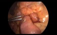 Duodeno-jejunale Anastomose bei Syndrom der Arteria mesenterica superior