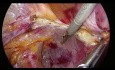 Laparoskopische Uterusarterie am Ursprung