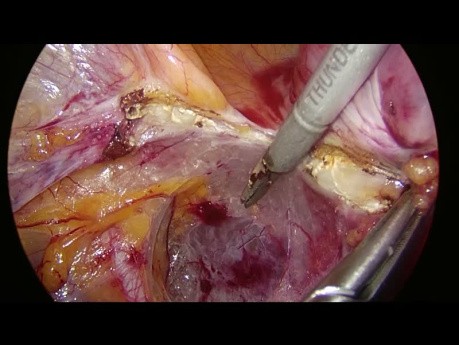 Laparoskopische Uterusarterie am Ursprung