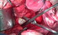 Beckenanatomie - 3 vordere avaskuläre Räume