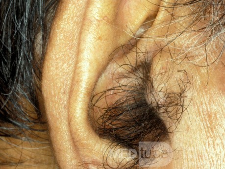 Borstenhaare am Tragus