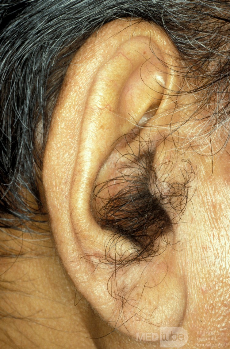 Borstenhaare am Tragus