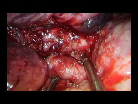 Rießiges Bronchialkarzinom - Single-Port-VATS Sleeve Resektion