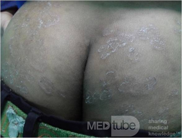 Tinea corporis