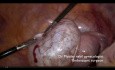 Fruchtbarkeitserhaltende Ovarialzystektomie
