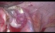 Laparoskopische Hysterektomie