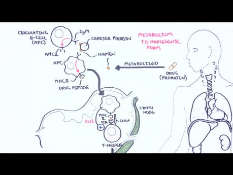 DRESS-Syndrom (medikamentenbedingte Eosinophilie) – Ursachen, Pathophysiologie, Anzeichen und Symptome, Behandlung