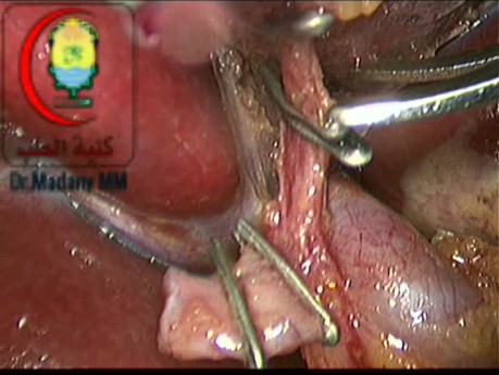 Bifurkation der Arteria cystica bei Vorhandensein die „Caterpillar hump“ der rechten Leberarterie