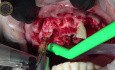 Zahnextraktion mit sofortiger Implantatinsertion