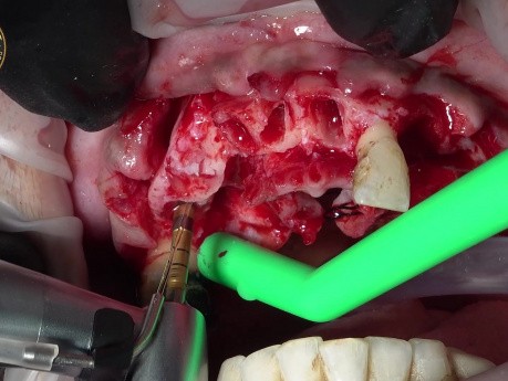 Zahnextraktion mit sofortiger Implantatinsertion