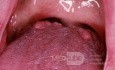 Prominente Papillae circumvallatae