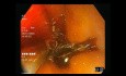 Weißlichtendoskopie vs. Schmalbandbildgebung (NBI) vs. Chromoendoskopie (mit Lugol-Jod)