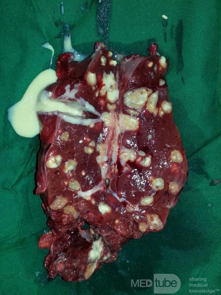 Milztuberkulose
