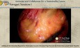 Minimalinvasive Entnahme eines Omentumlappens für den Lymphknotentransfer an den Extremitäten