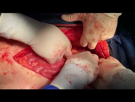 Thorakoabdominelles Aorten-Debranching für Patienten mit einer einzelnen Niere
