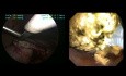 Laparoskopische Choledokusrevision zur Entfernung von 45 intra- und extrahepatischen Steinen