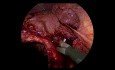 Laparoskopische Cholezystektomie bei akuter kalkhaltiger Cholezystitis mit Leberzirrhose und portaler Hypertonie s/p Perkutane Cholezystostomie