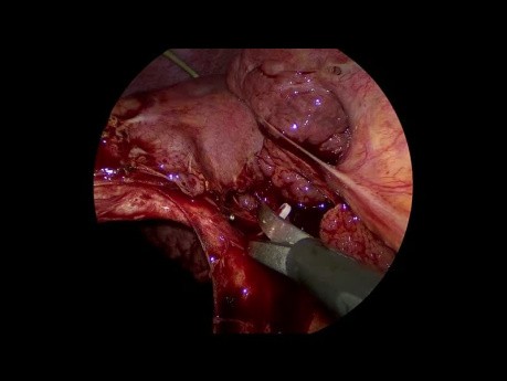 Laparoskopische Cholezystektomie bei akuter kalkhaltiger Cholezystitis mit Leberzirrhose und portaler Hypertonie s/p Perkutane Cholezystostomie