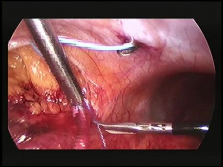 Retrokavaler Ureter: Laparoskopische Transposition von retrokavalem Ureter und ureteroureterischer Anastomose