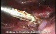 Bipolare Schere (ERAGON Handgriff) und laparoskopische Hysterektomie