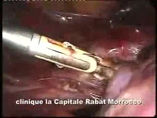 Bipolare Schere (ERAGON Handgriff) und laparoskopische Hysterektomie