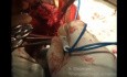 Vaginale Hysterektomie Morcellation