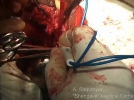 Vaginale Hysterektomie Morcellation