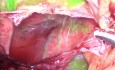 Fluoreszenzbildgebung mit Indocyaningrün (ICG) während der laparoskopischen Fensterung einer Leberzyste