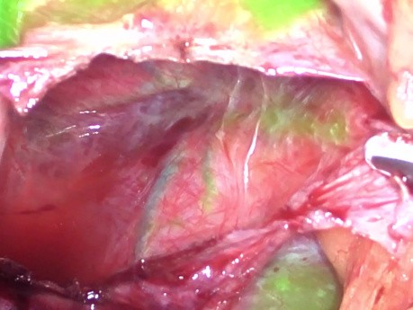 Fluoreszenzbildgebung mit Indocyaningrün (ICG) während der laparoskopischen Fensterung einer Leberzyste