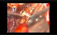Gehirnaneurysma – Bifurkation der mittleren Hirnarterie – mikrochirurgische Clipping-Operation