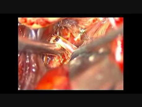 Gehirnaneurysma – Bifurkation der mittleren Hirnarterie – mikrochirurgische Clipping-Operation