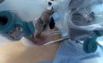 Robotergestützte totale laparoskopische Hysterektomie über nur einen Port