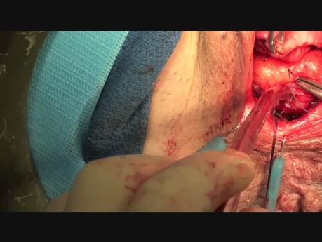 Plastiche Chirurgie der Rektozele