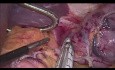 Laparoskopische Fundusresektion - GIST