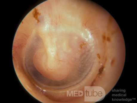 Neurinom des Nervus facialis im Mittelohr