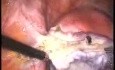 Laparoskopische bilaterale Adnexektomie