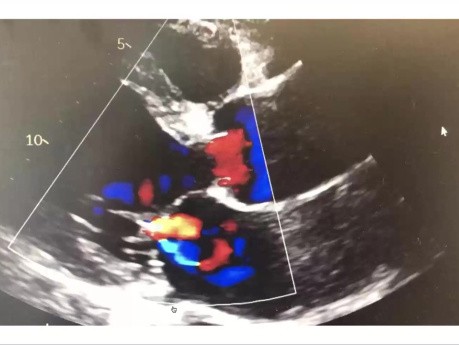 Echokardiographische Bewertung der Aorteninsuffizienz.