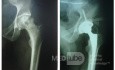 Implantation einer totalen Hüftendoprothese