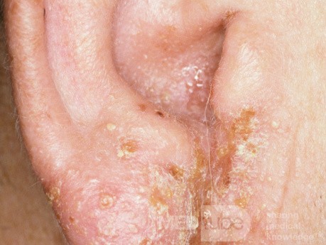 Neomycin-Kontaktdermatitis