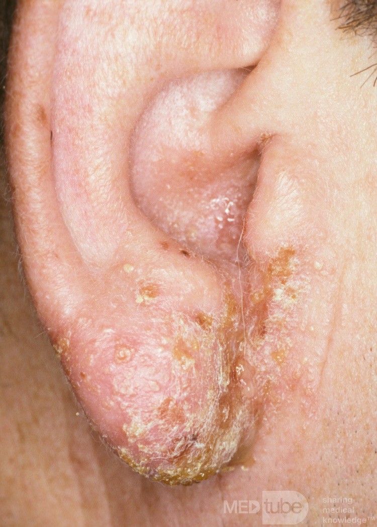 Neomycin-Kontaktdermatitis