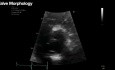 Echokardiographische Bewertung der Aortenstenose