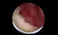 TURP – Abszess der Prostata