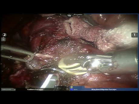 Segmentektomie S2 - roboterassistierte Chirurgie