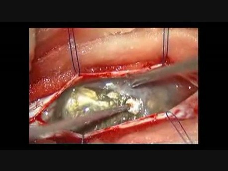 Spinales intradurales Epidermoid – mikrochirurgische Entfernung