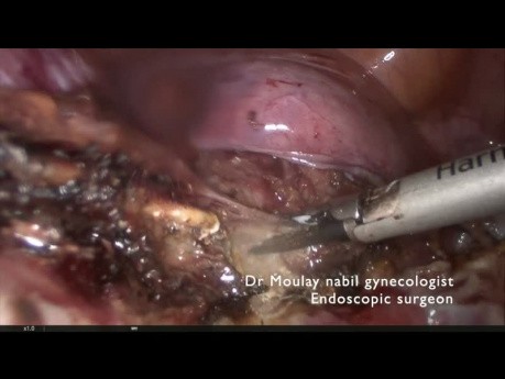 Totale laparoskopische Hysterektomie bei einer Patientin mit großem Uterus